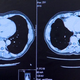 Illustration for article titled Cancer immunotherapy in the news: What is PD-1?